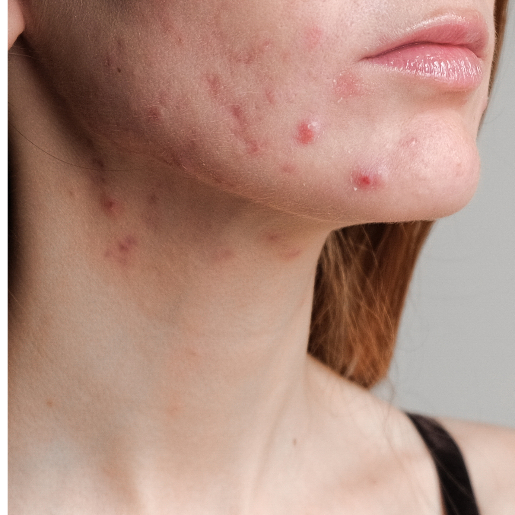Acne