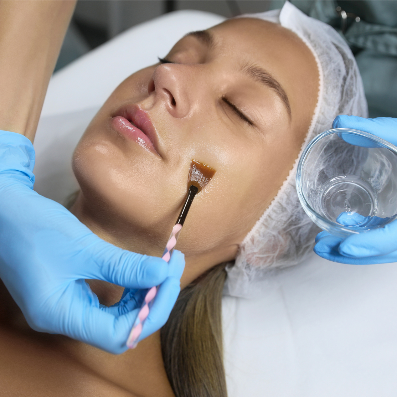 Chemical Peel
