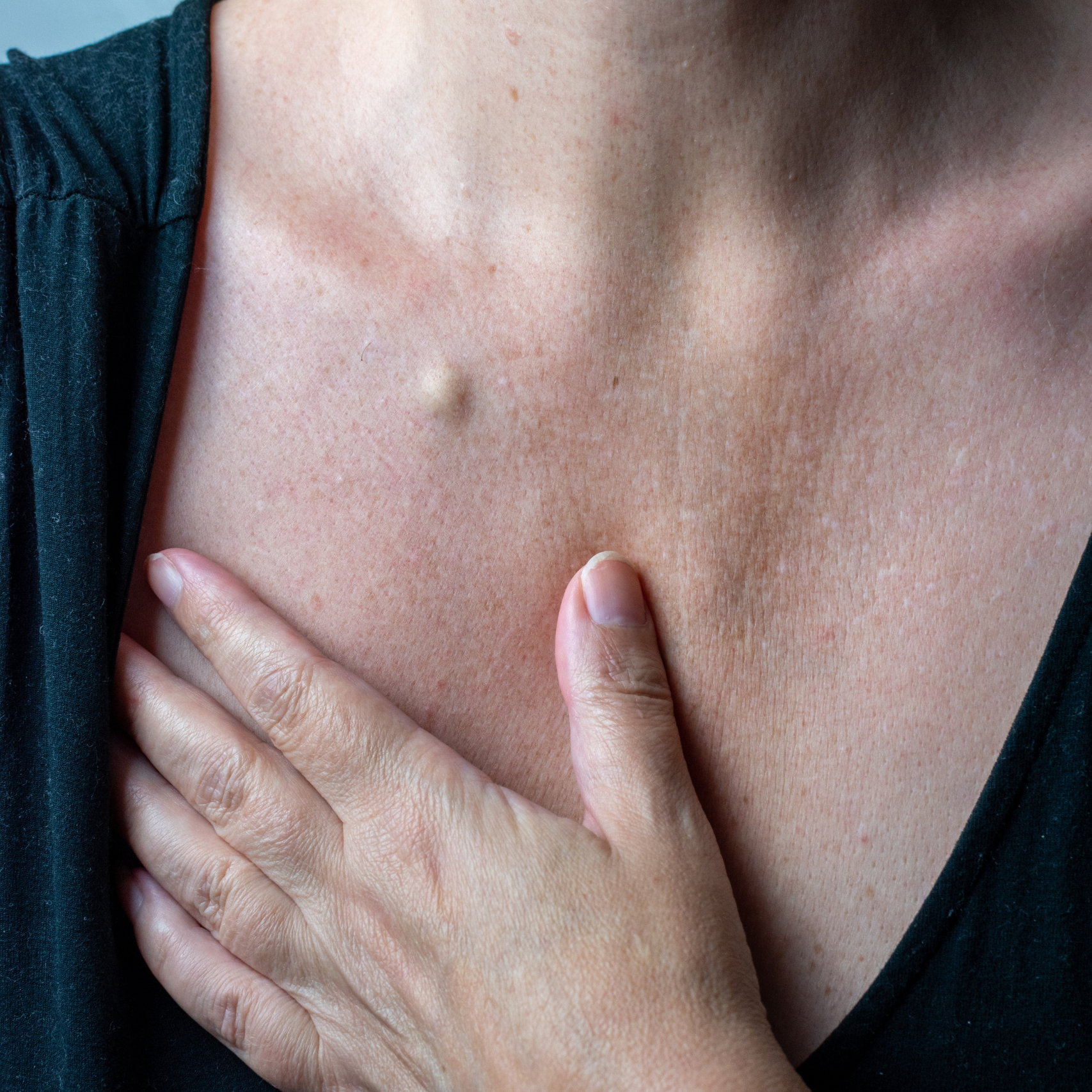 Cyst Excisions