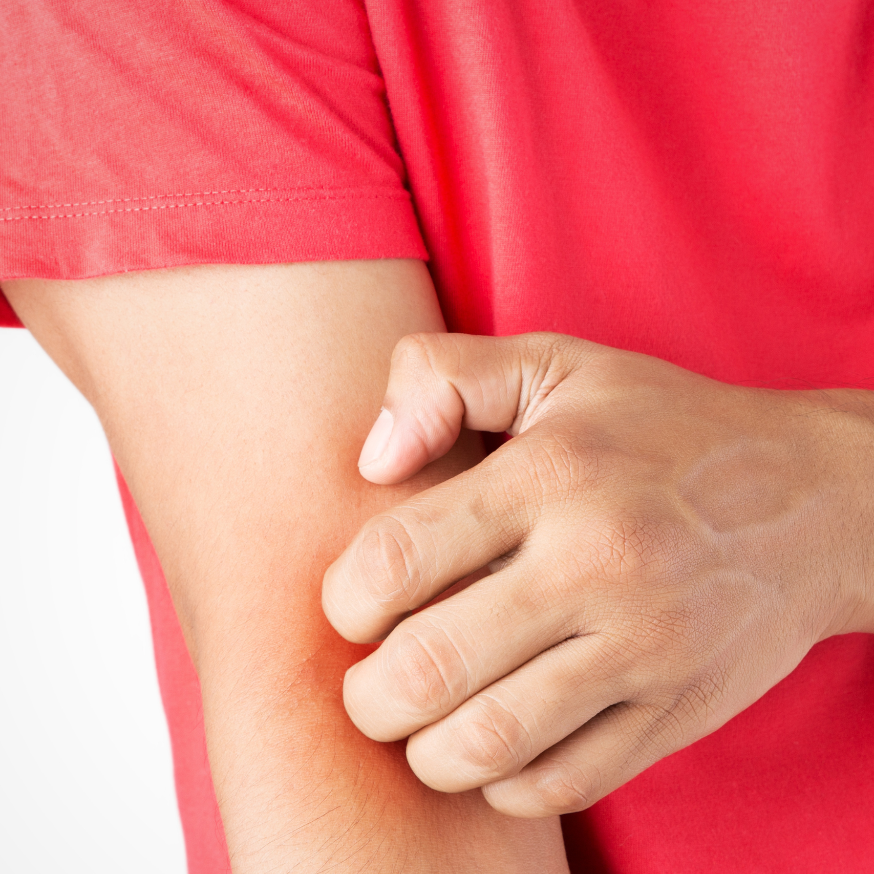 Eczema