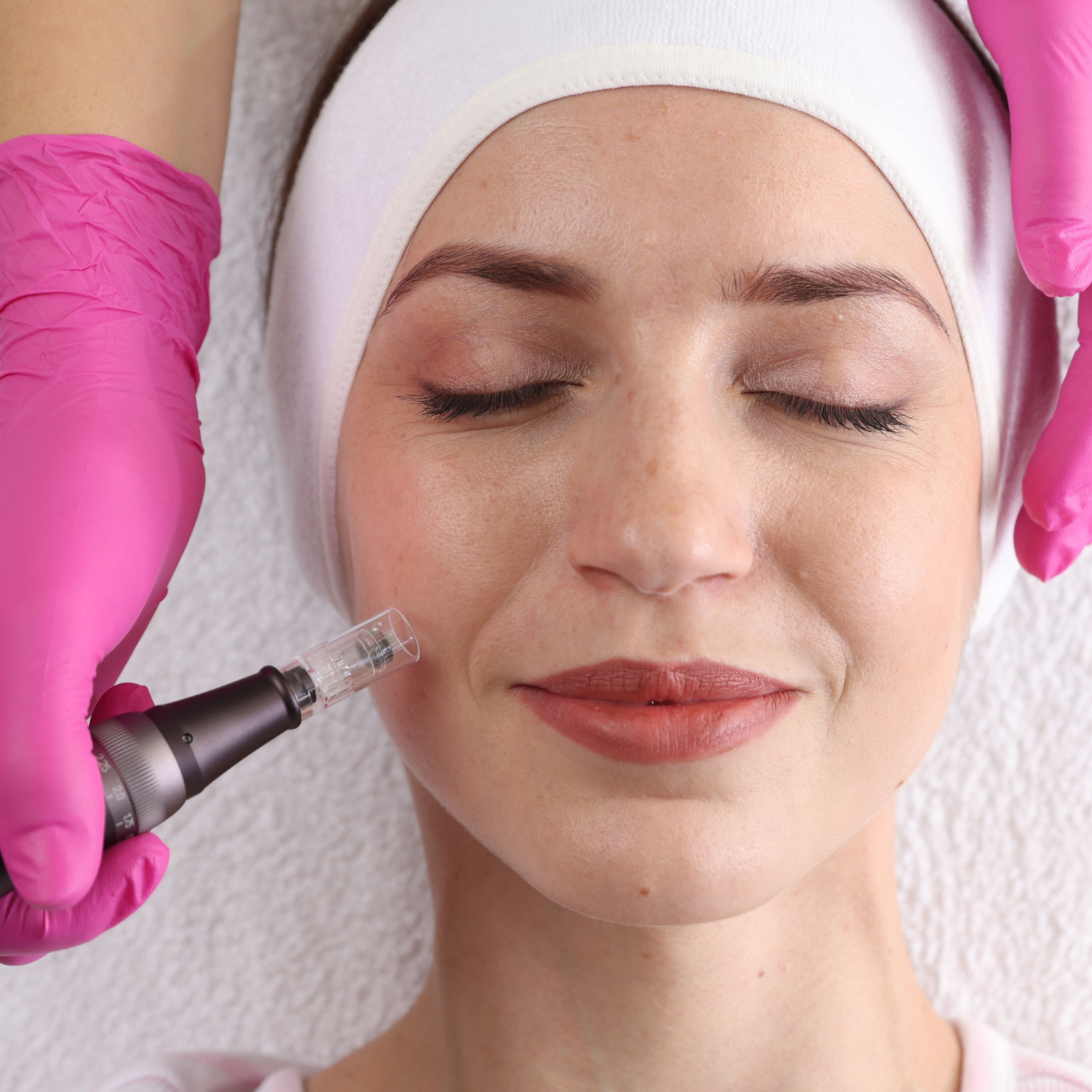 Microneedling