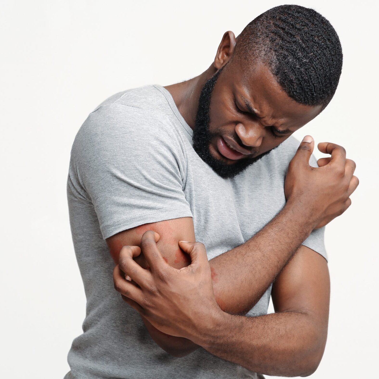 Psoriasis
