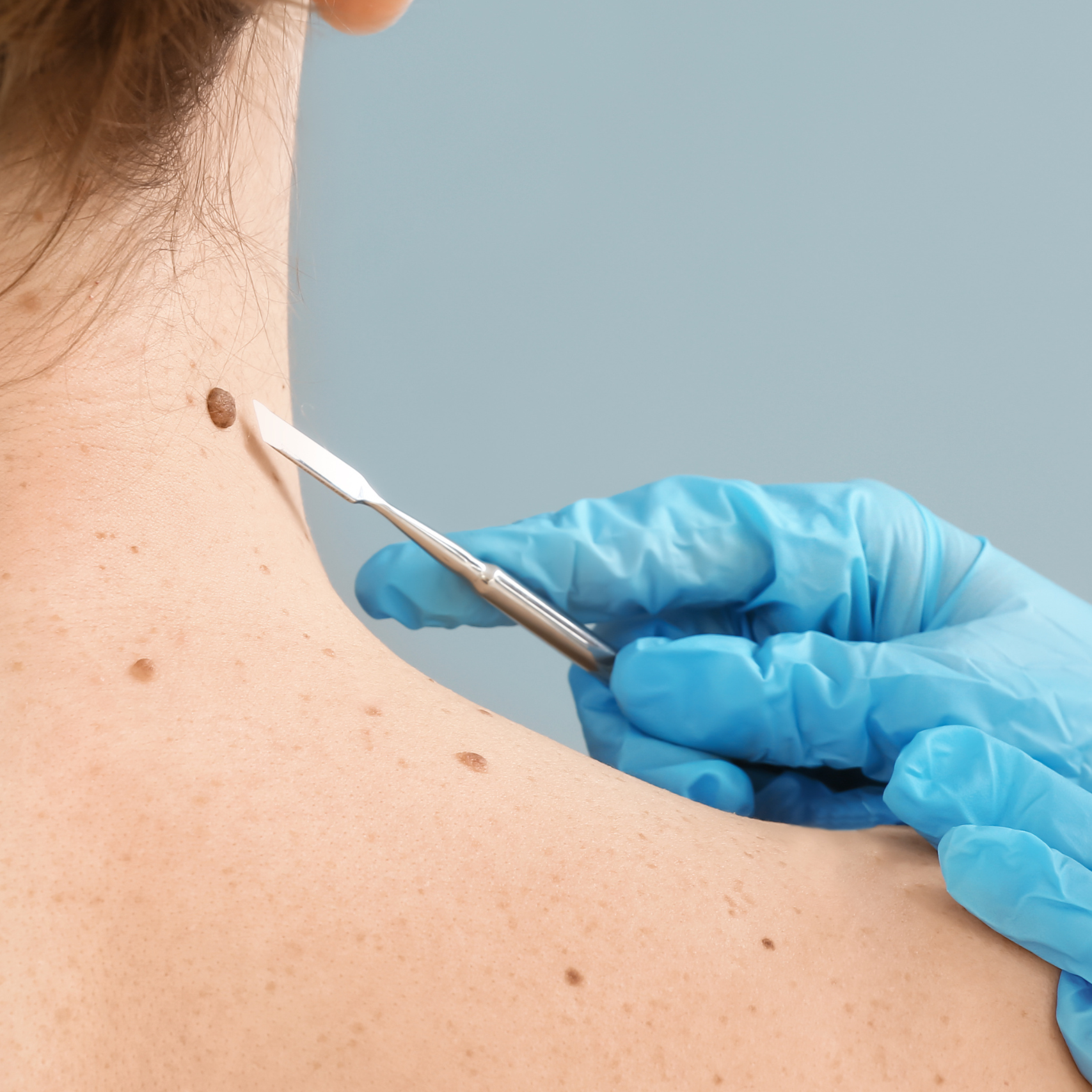 Skin Cancer